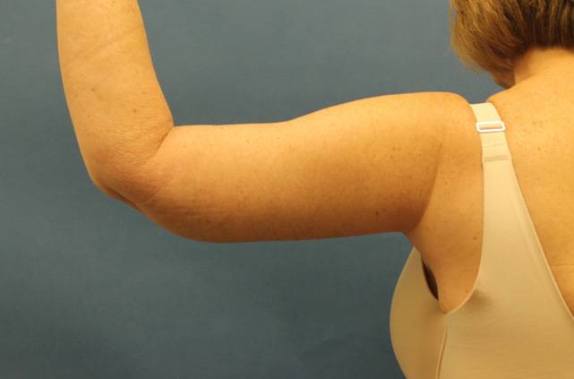 after arm lift