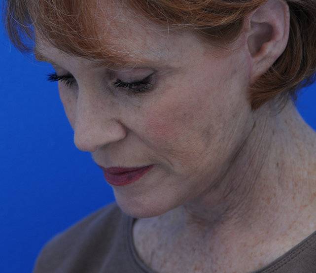 neck lift after
