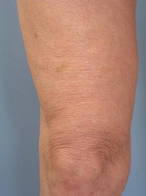 thermage after photo