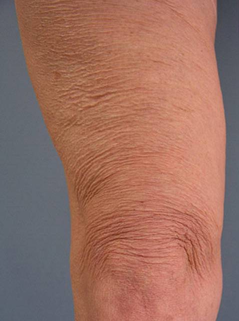 thermage before photo