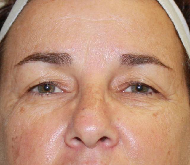 eyelid surgery before photo