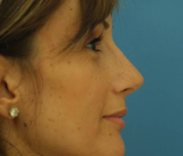 side rhinoplasty after