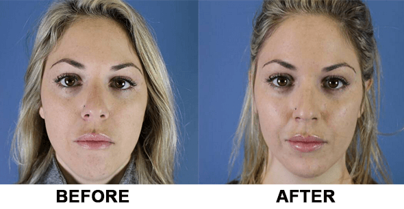 facial balancing before and after with restylane filler