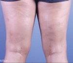 sclerotherapy