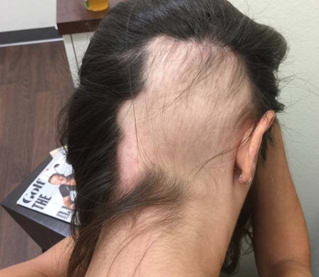 before proplasma hair restoration