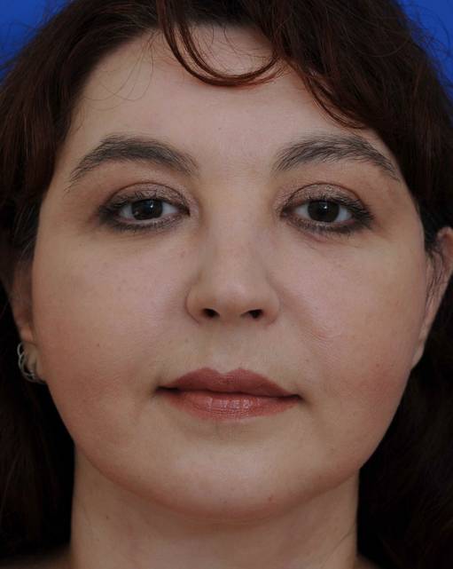 patient 100191 lip implants front view after