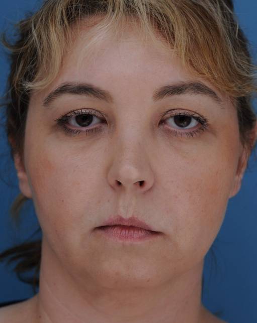 patient 100191 chin implant front view after