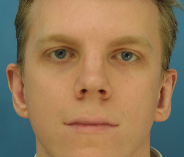 otoplasty after
