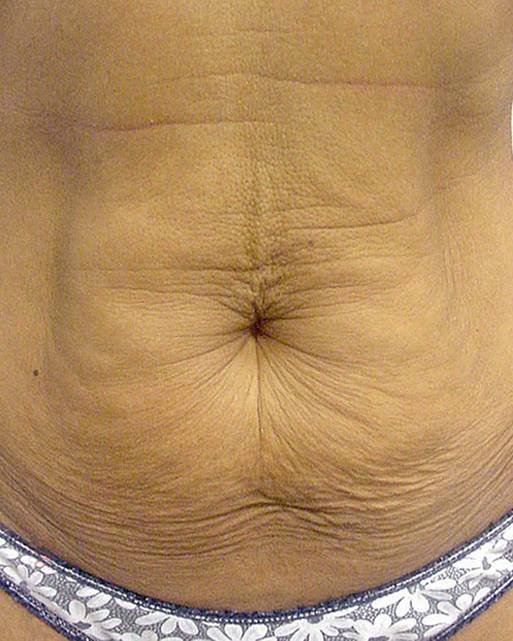 before thermage