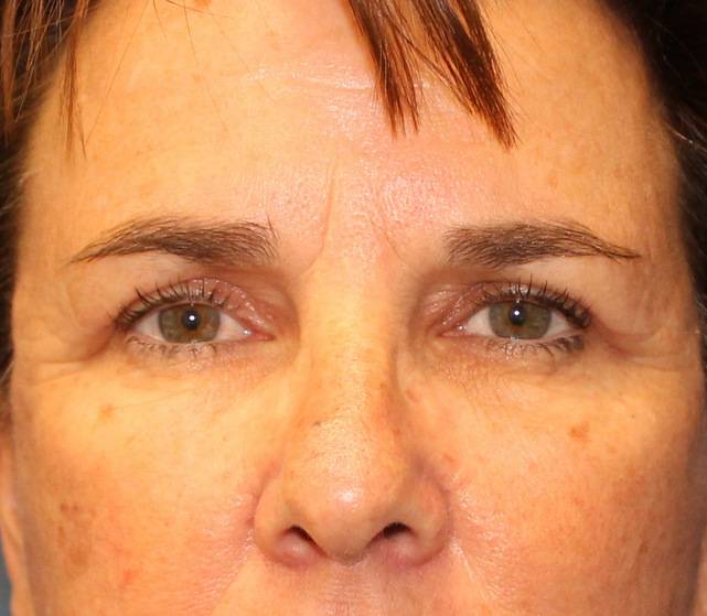 eyelid surgery after photo