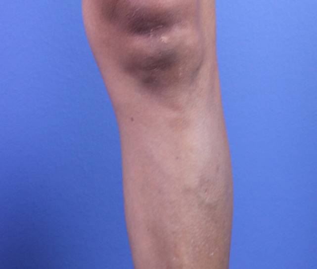 patient A phlebectomy left leg after
